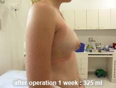 plastic-surgery-breast-augmentation 